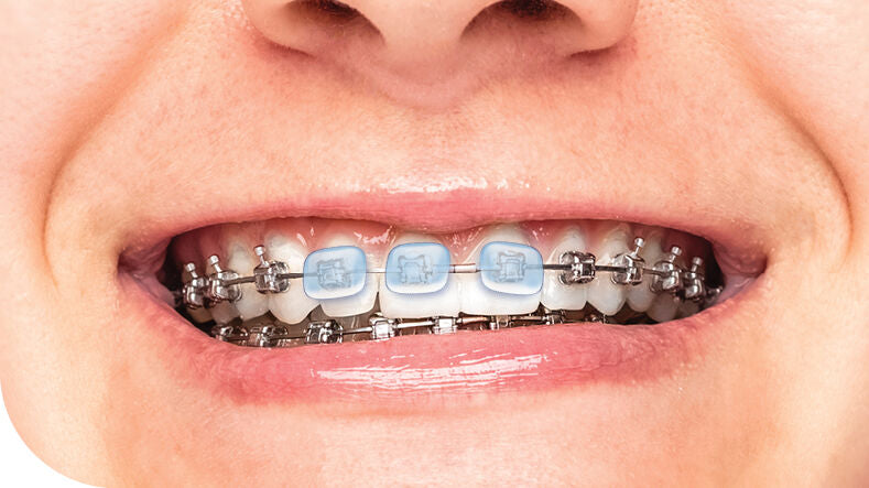 Piksters Braces Wax Dots (12 Pack)