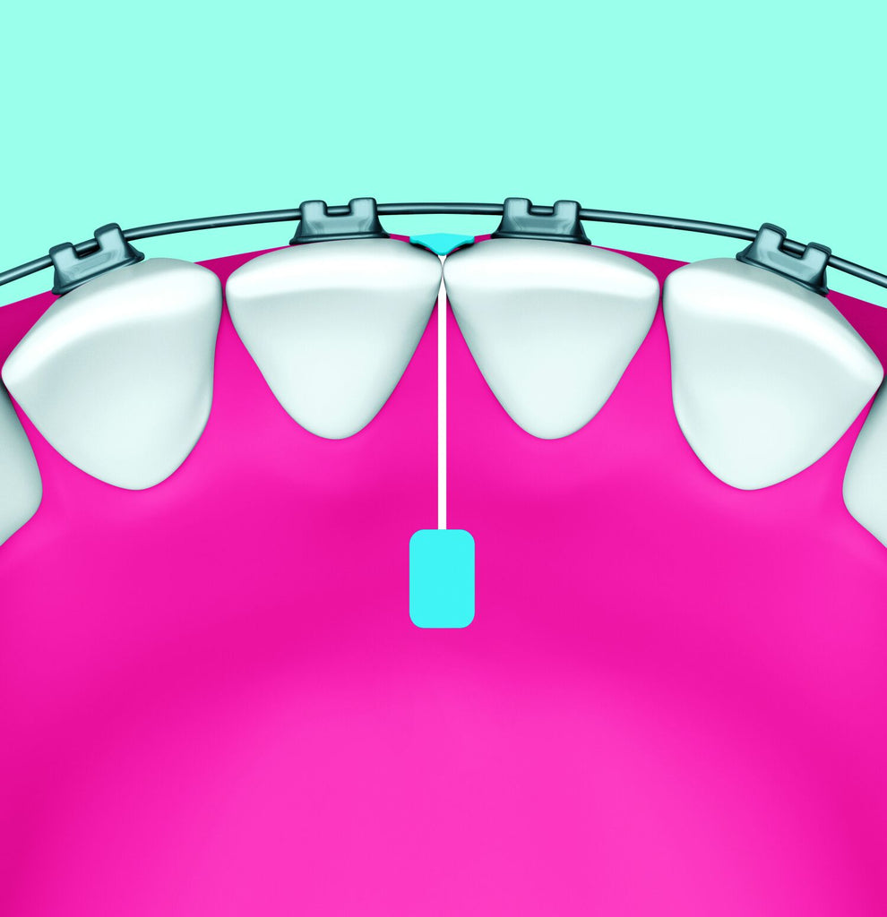 Piksters Supagrip for Braces (20 Pack)